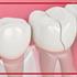 چگونه یک دندان ترک خورده را درمان کنیم؟